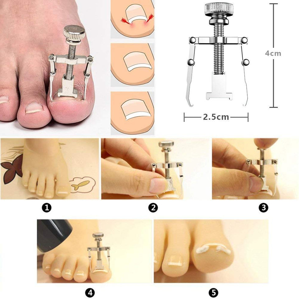 Kit de herramientas para uñas encarnadas de 6Pcs / set, herramienta para pies de tratamiento de uñas Premium, cortapelos de corrección de remoción de uñas encarnadas, lima y levantador de uñas con punta entallada para cirugía